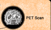 PET Scan