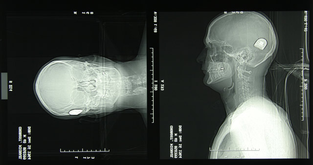 X-ray of a Cochlear Implant